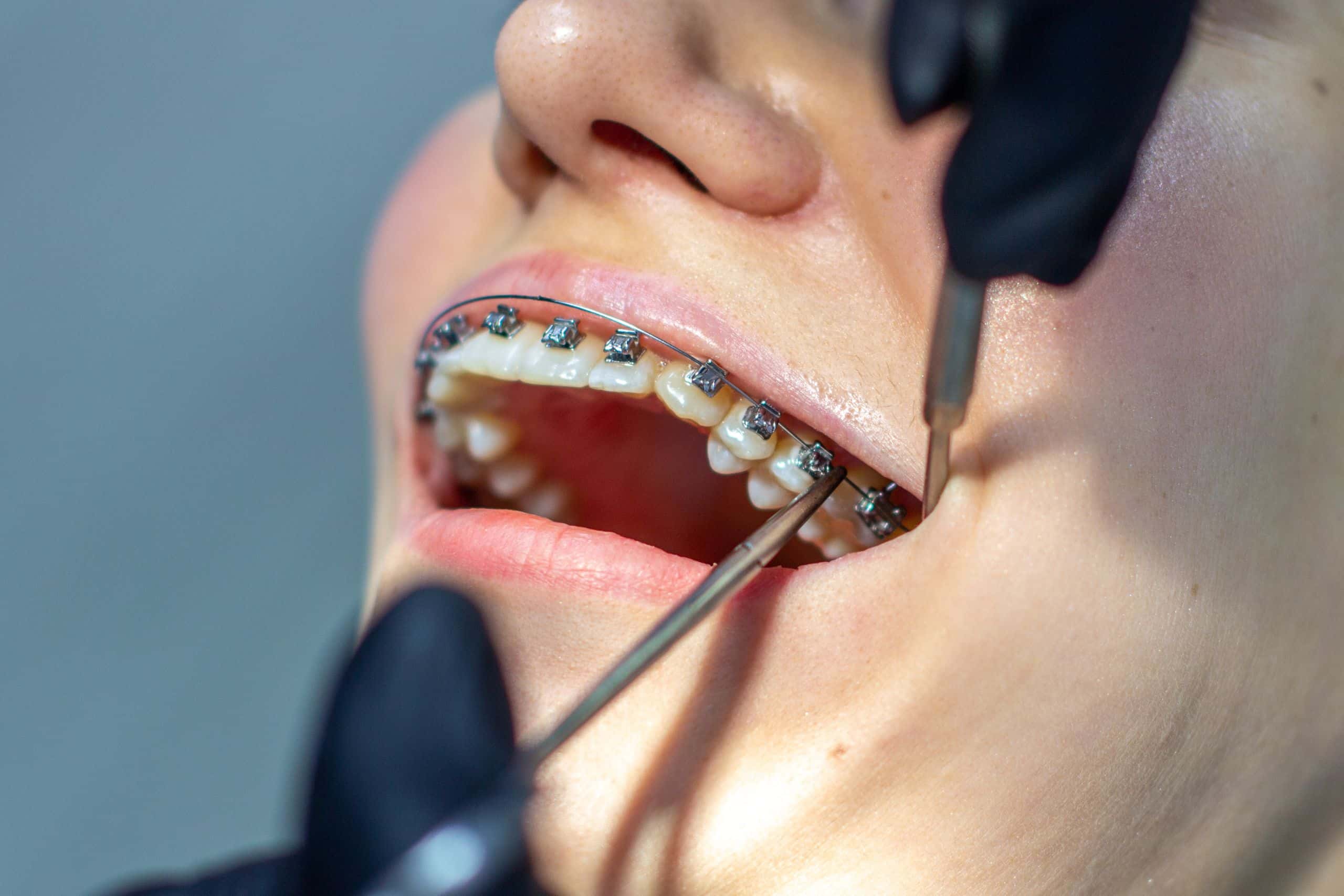 The general dental professional is giving bone healing insights for using braces