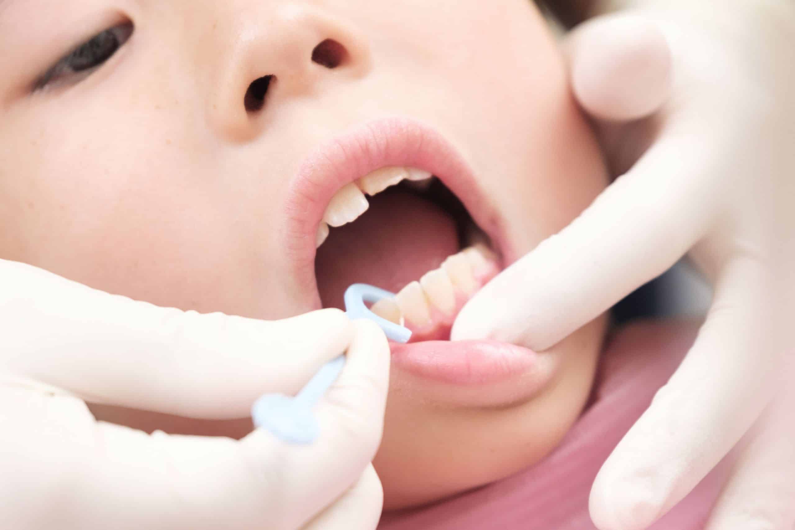 Pediatric dentist is deciding whether the child needs a tooth removal