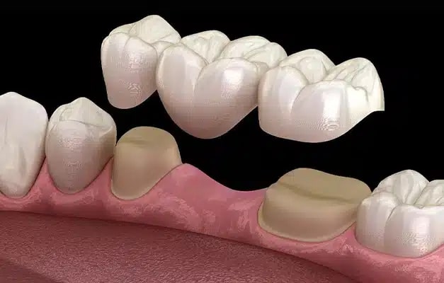 Dental Bridges served by general dentist at Altamonte Springs