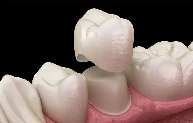 Dental Crowns served by general dentist at Altamonte Springs