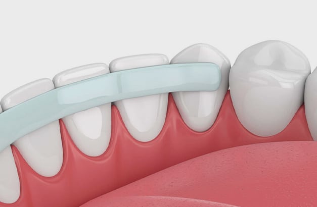 Procedure of cosmetic dental bonding  at Altamonte Springs