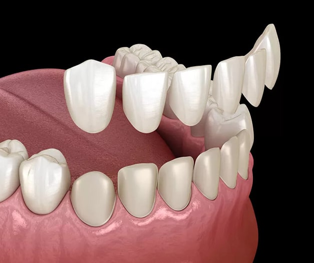 Procedure of cosmetic dental veneers at Altamonte Springs